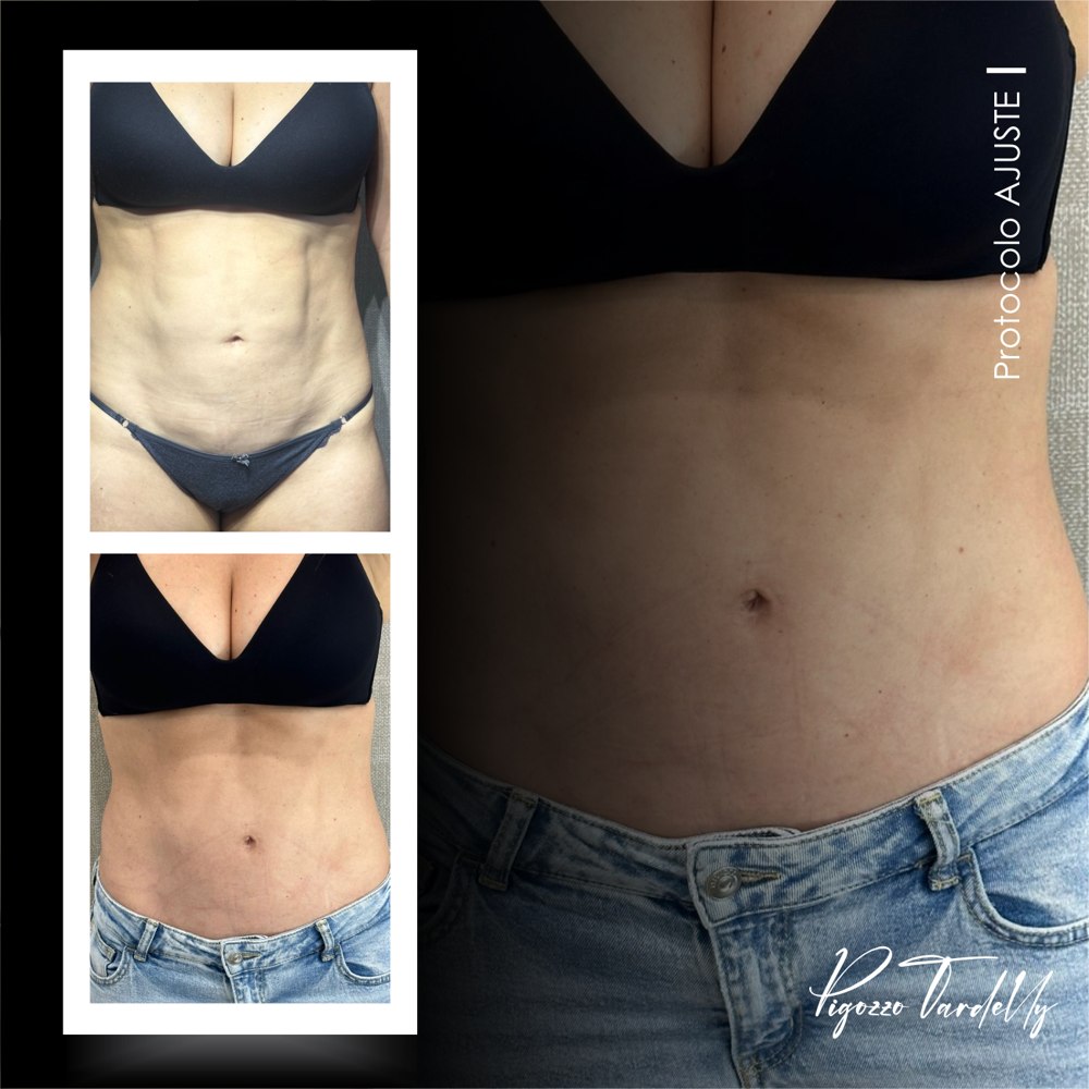 Antes e depois — Protocolo Ajuste