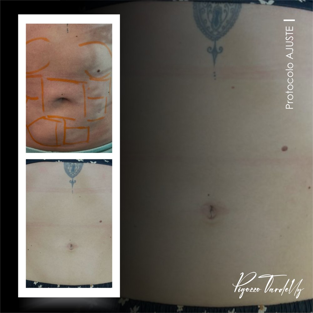 Antes e depois — Protocolo Ajuste