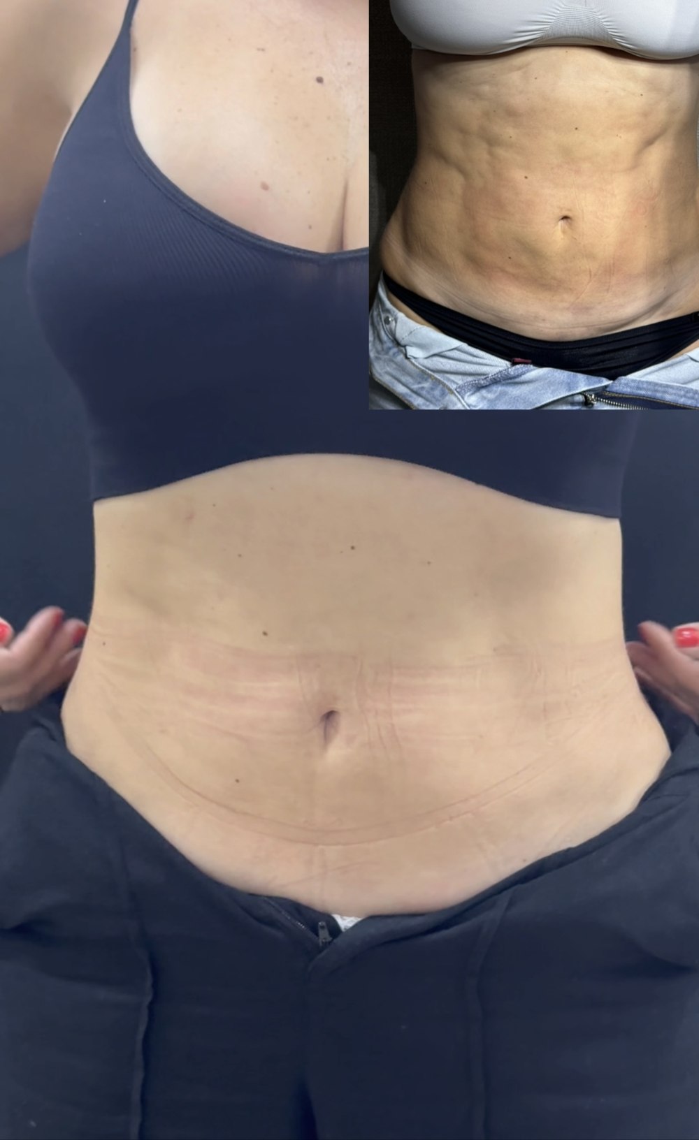 Antes e depois — Protocolo Ajuste