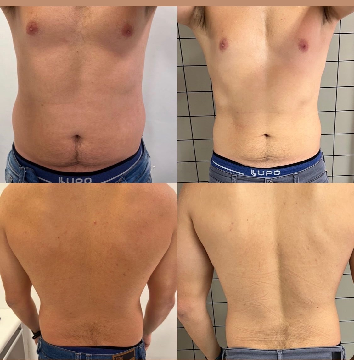 Antes e depois — Protocolo Medida, frente e costas