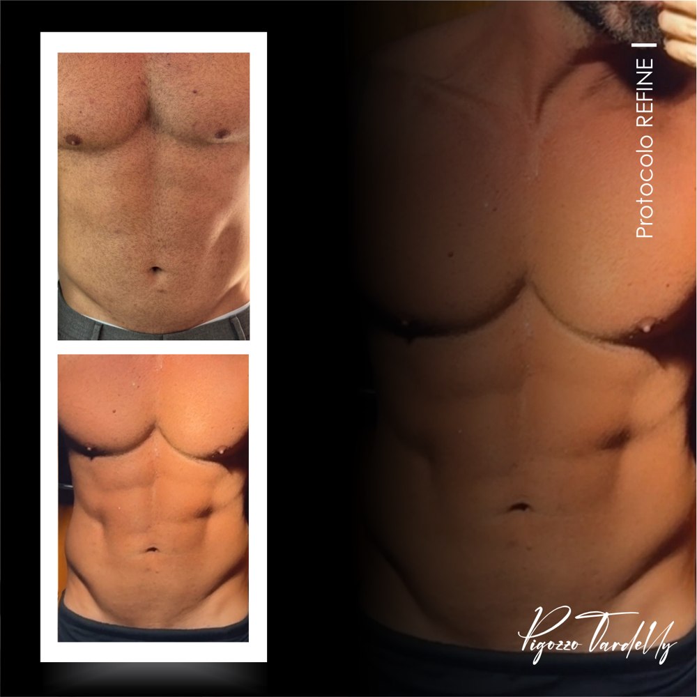 Antes e depois — Protocolo Refine