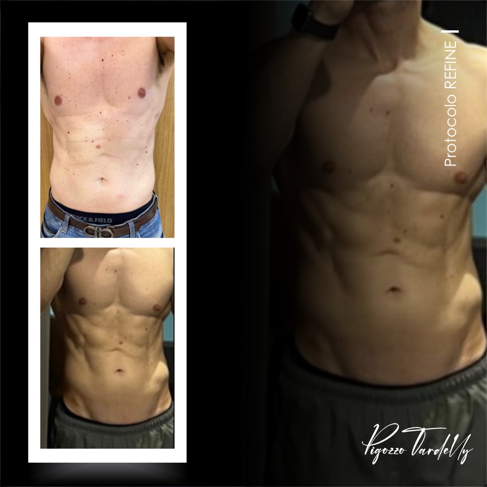 Antes e depois — Protocolo Refine