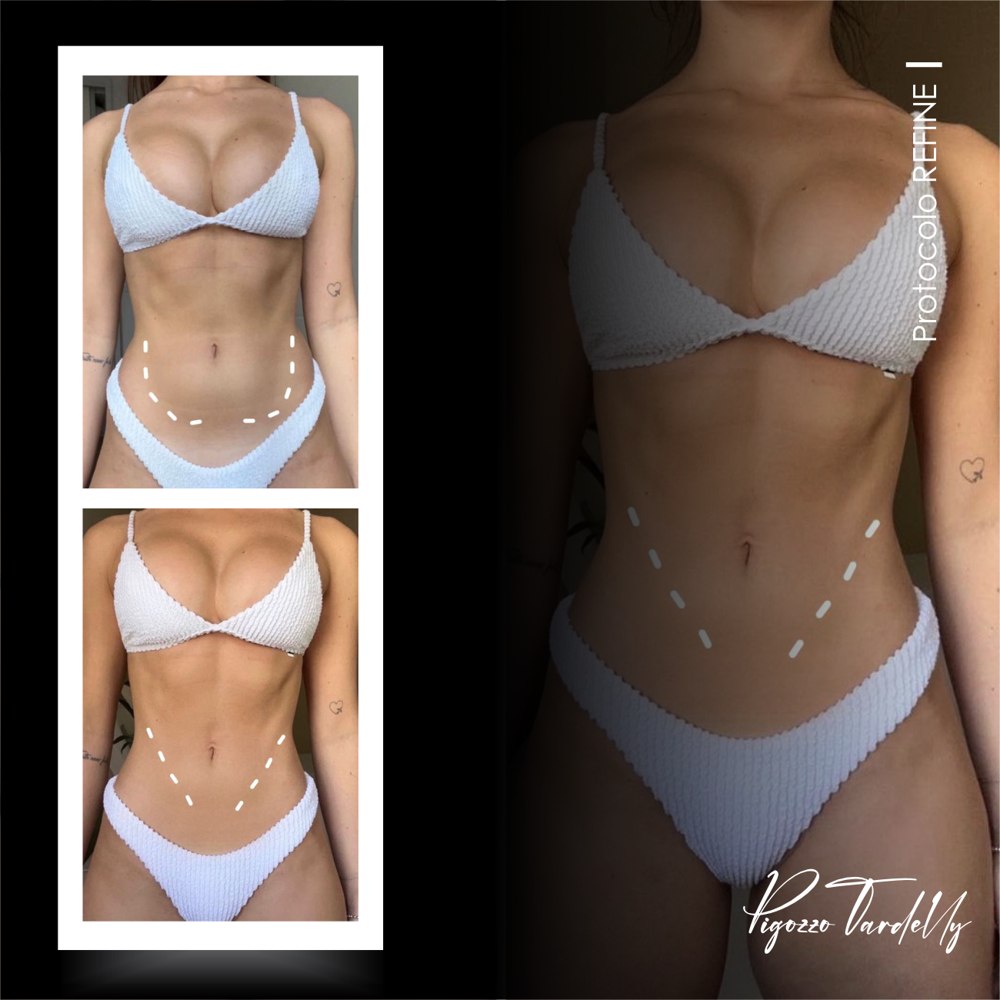 Antes e depois — Protocolo Refine